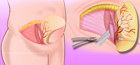 Breast Cancer in Coimbatore