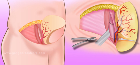 Breast Cancer in Coimbatore