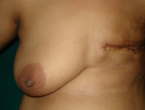 Breast Reconstruction