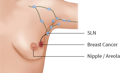 Ganga Breast Cancer in Coimbatore