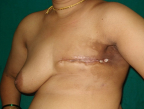 Breast Reconstruction