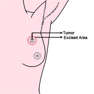 Ganga Breast Cancer in Coimbatore